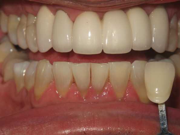 Implant Crowns After Image