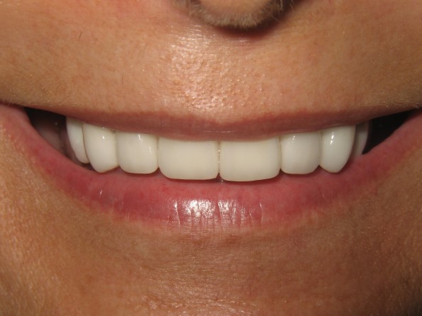 Implant Crowns After Image