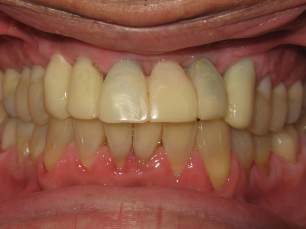 Implant Crowns Before Image