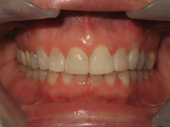 Invisalign After Image